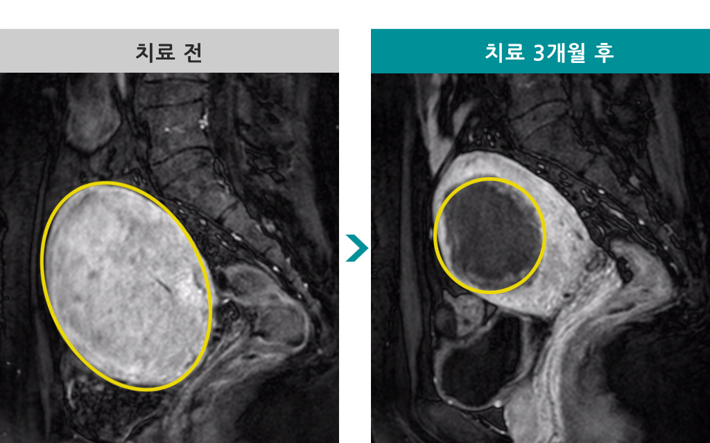 44세미만성자궁선근증00841659.jpg