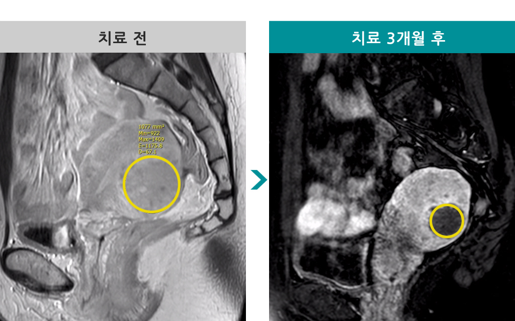 37세00844517색전술.jpg