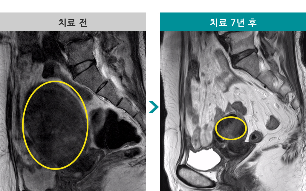 48세00808364자궁근종색전술.jpg