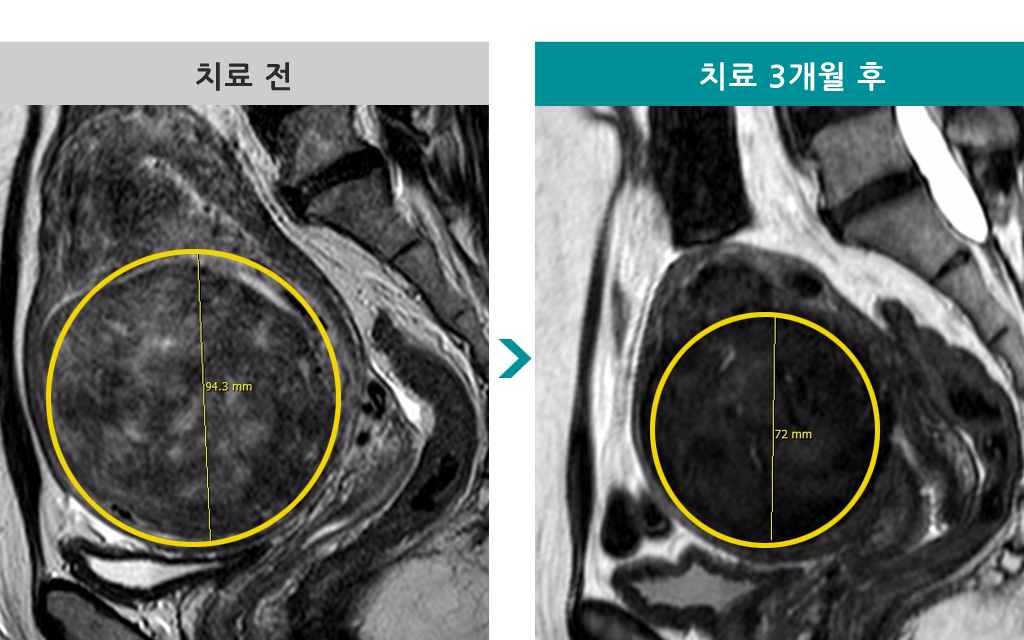 42세선근증색전술.jpg