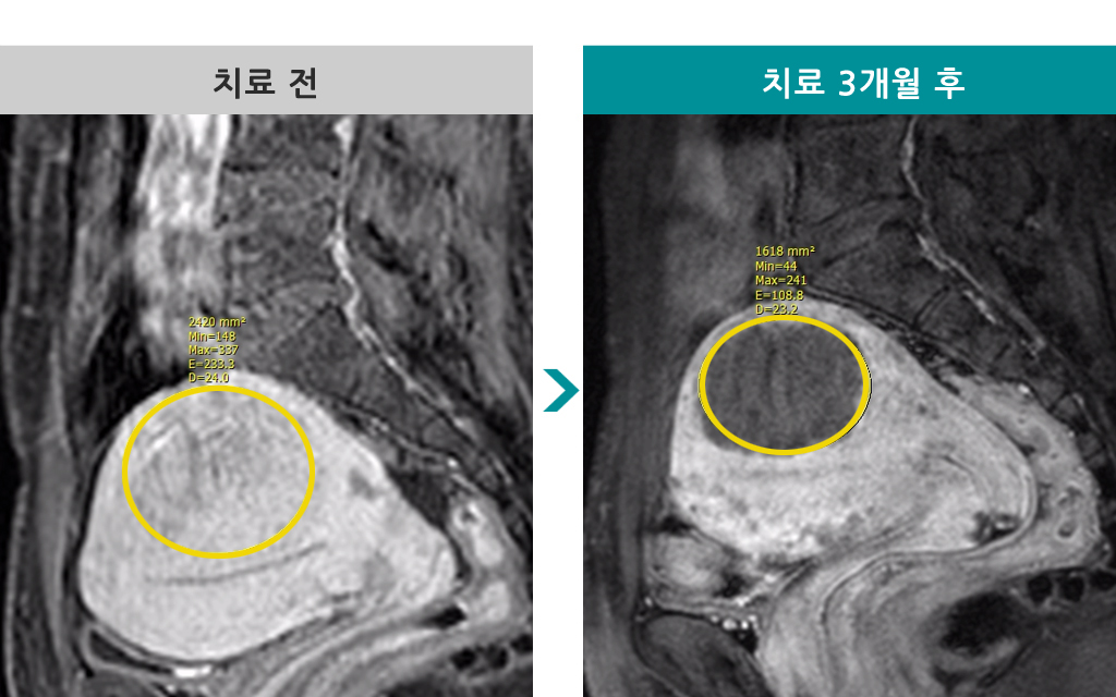 49세00844789선근증색전술.jpg