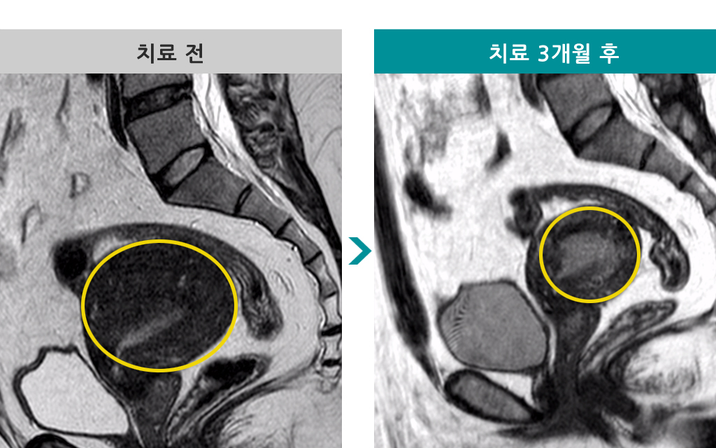 35세00845807미만성선근증.jpg