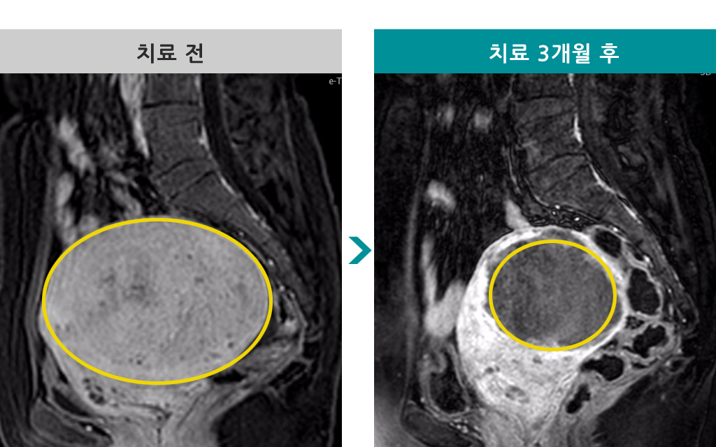 51세미만선성근증색전.jpg