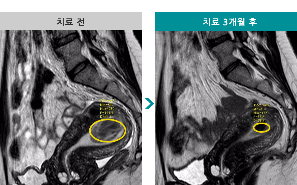 42세00849879색전술.jpg