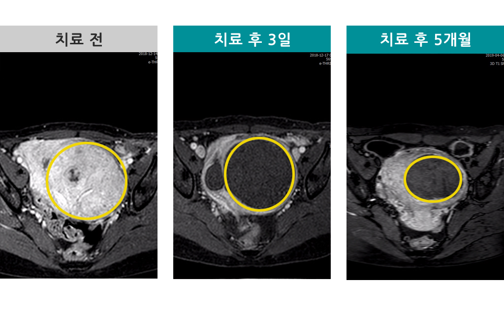 47세00847022색전술.jpg